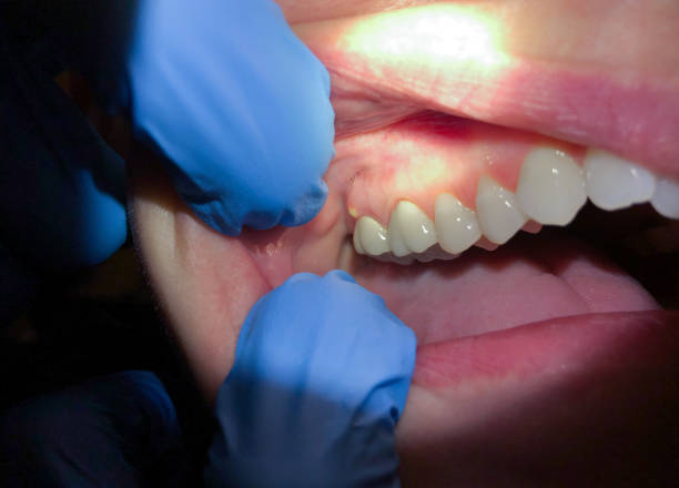 Best Emergency Dentist for Lost Fillings or Crowns in Middletown, OH